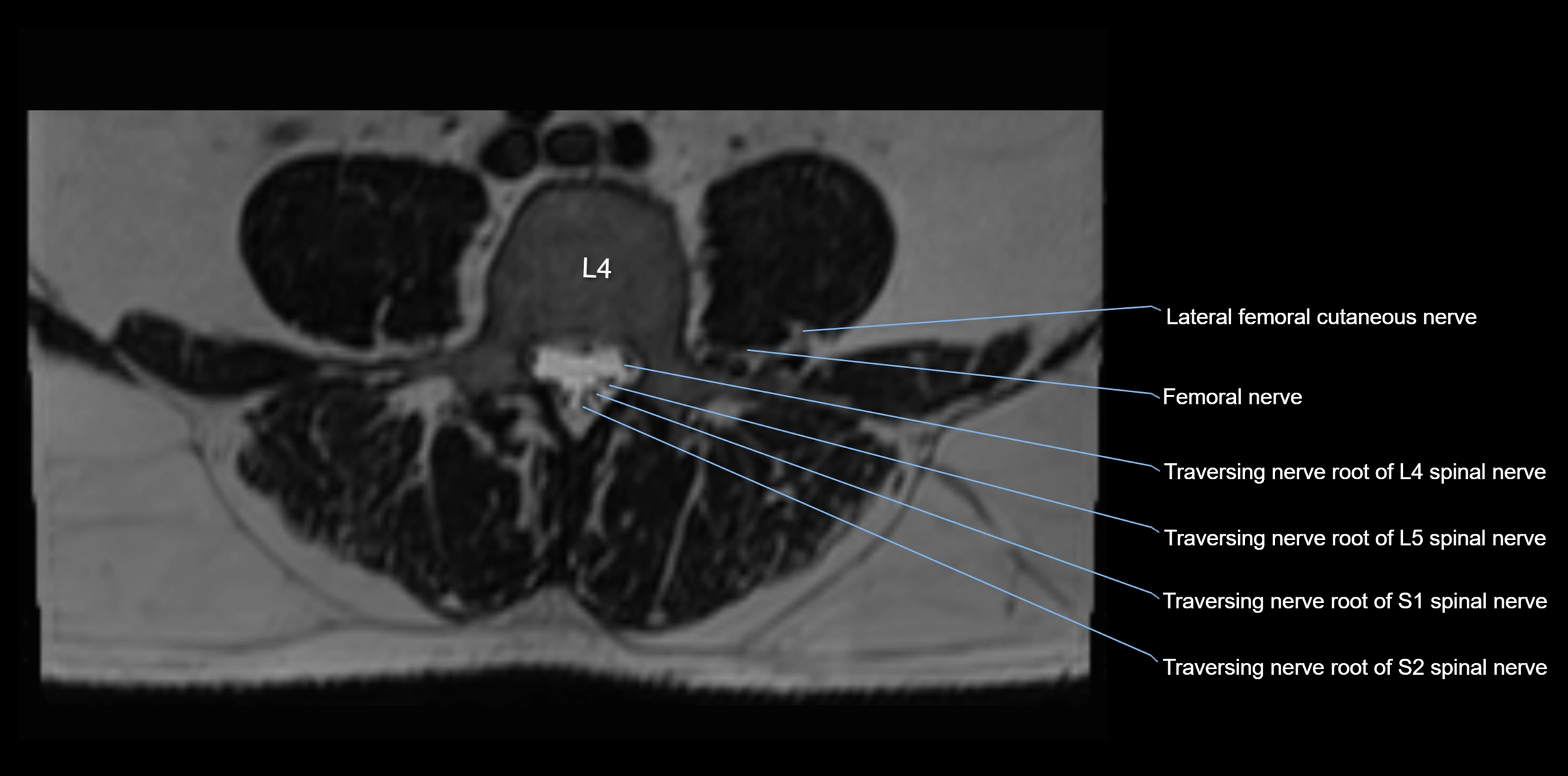 MR lumbosacral plexus axial cross sectional anatomy 3T  radiology  image-img-1008001-00037.webp